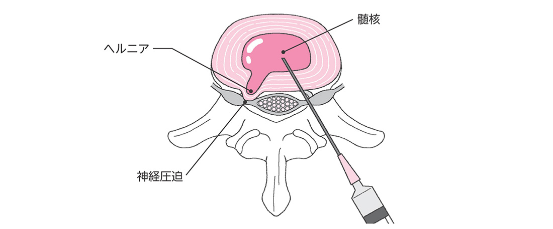 コンドリアーゼ(ヘルニコア)を使用した椎間板内治療のイメージ