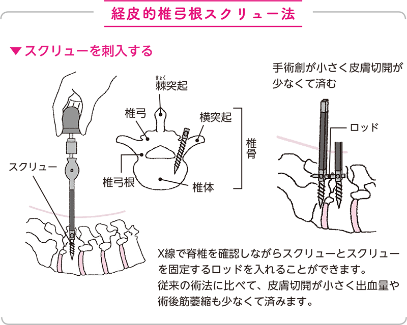 後方椎体間固定術(PLIF Posterior Lumbar Interbody Fusion, TLIF Transforaminal Lumbar Interbody Fusion)の図
