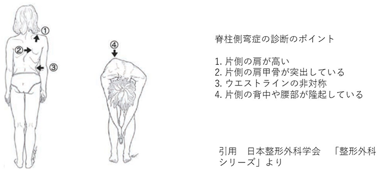 側弯症画像